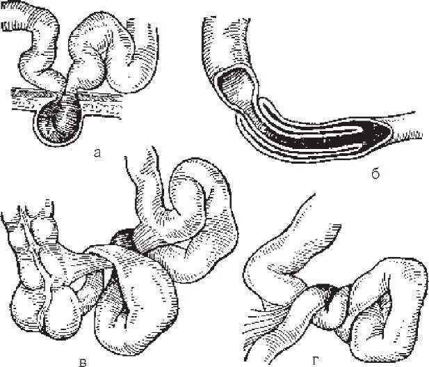 Слепая кишка кролика. Заворот кишок непроходимость кишечника. Острая кишечная непроходимость заворот кишок. Заворот сигмовидной кишки. Заворот кишок (инвагинация).