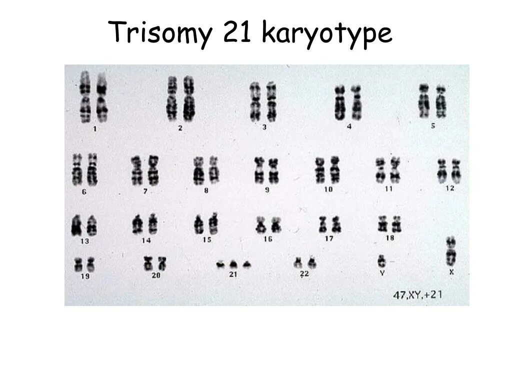 Трисомия 21 кариотип. Лишняя 21 хромосома