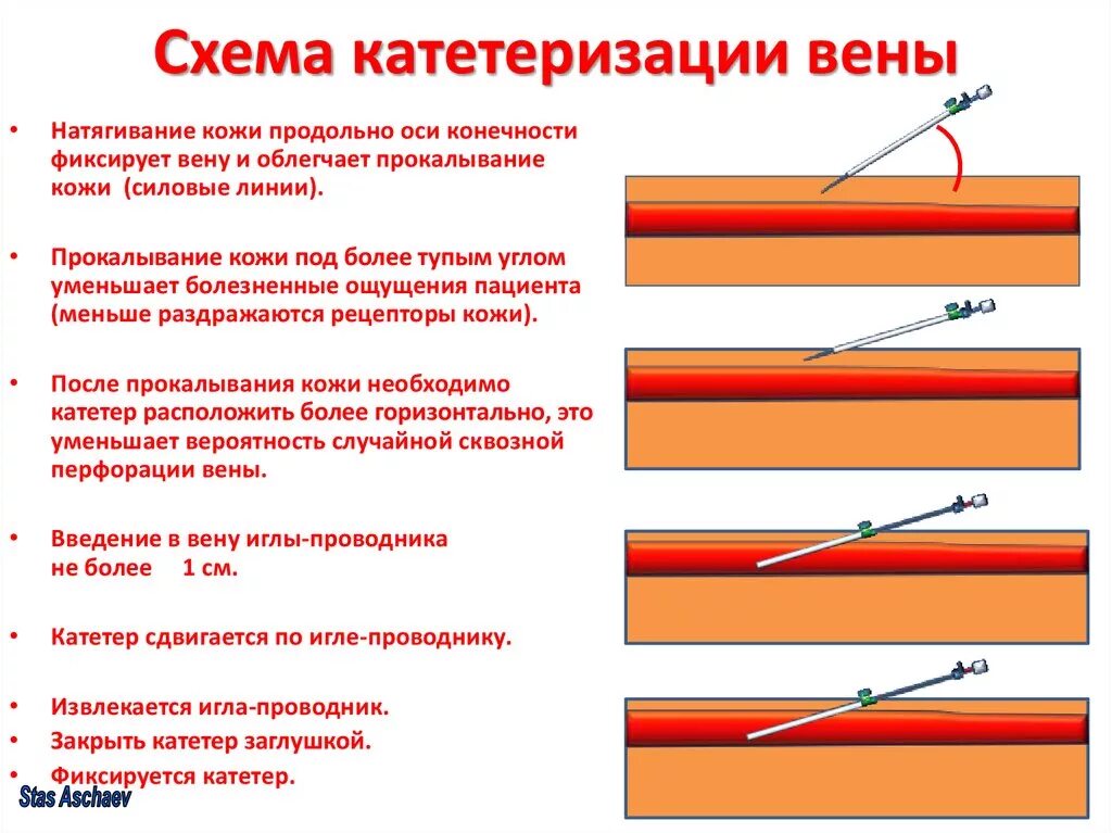 Постановка внутривенного катетера алгоритм. Периферический катетер алгоритм действия. Схема постановки периферического катетера. Постановка периферического катетера алгоритм. Осложнения катетеризации вены