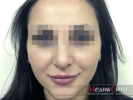 Ринопластика отек сколько