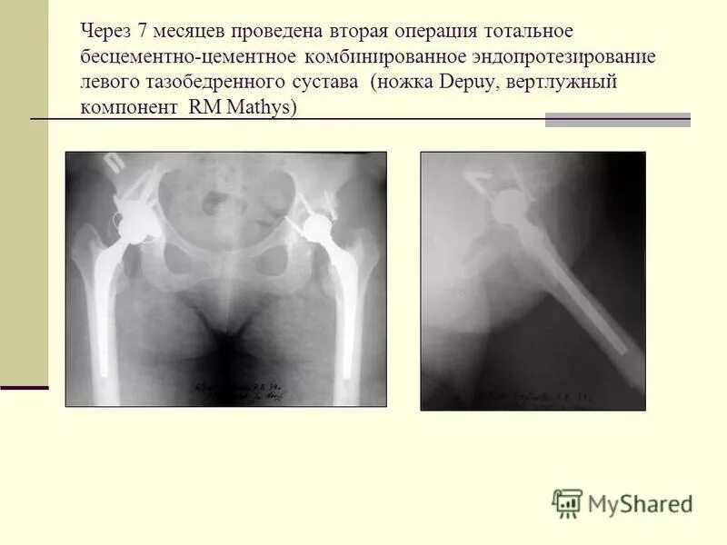 Патологический перелом бедра