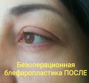 Безоперационная блефаропластика отзывы до и после