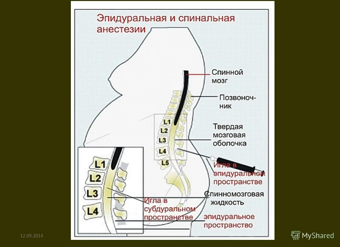 Анестезия при беременности при лечении