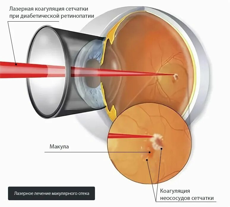 Лазерная фотокоагуляция сетчатки. Лазеркоагуляция сетчатки глаза. Лазерная коагуляция сетчатки при диабете. Ограничительная лазеркоагуляция сетчатки глаза.