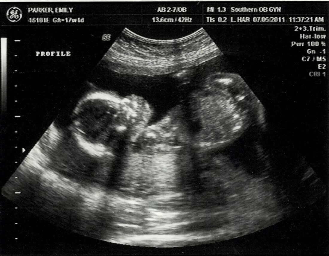 Фото мальчика 12 недель. Пол плода на 12 неделе беременности по УЗИ. УЗИ беременности пол 2022. Пол ребёнка на УЗИ 20 недель. Снимок УЗИ на 12 неделе.