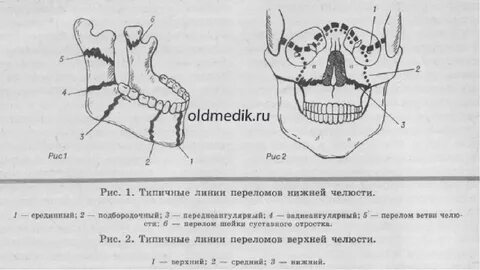 Переломы челюстей студфайл