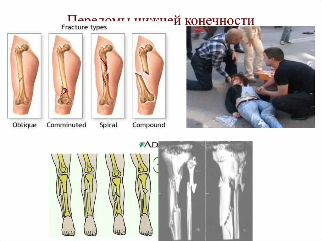 Типичные переломы верхних конечностей. Переломы нижних конечностей. типичные переломы нижних конечностей. переломы костей нижних конечностей. типичные переломы костей нижних конечностей.