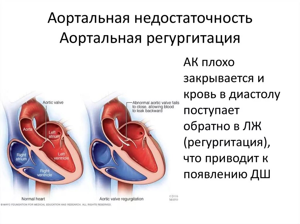 Недостаточность аортального клапана 1 ст. Аортальная клапанная недостаточность 135.1. Недостаточность клапана аорты схема. Аортальная регургитация 0 степени. Регургитацией называется