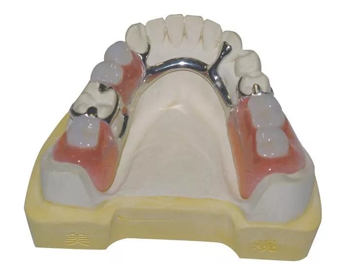 Каркас протеза. Многозвеньевой шинирующий кламмер. Моделировка каркаса бюгельного протеза. Бюгельный протез кламмерный (remanium-700). Каркас протеза.