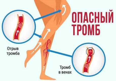 Сколько у человека тромбов