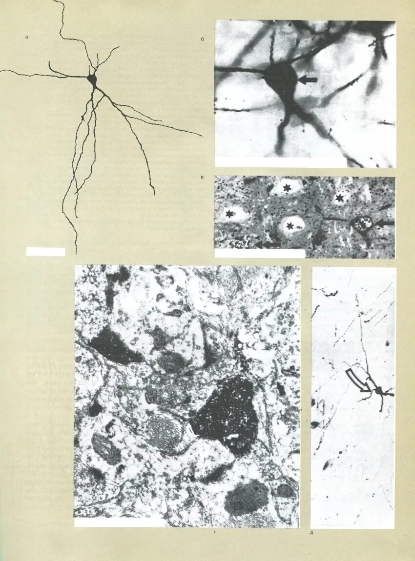 Хроматолиз нейронов. Некробиотические изменения нейронов. Тигролиз нейронов. Пикноз ядра. Клетки с гиперхромными ядрами
