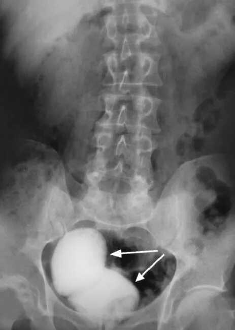 Что делать если камень застрял в мочеточнике. Конкремент мочеточника рентген. Камень в мочевом пузыре рентгенограмма. Камни в мочевом пузыре рентген экскреторная урография. Камни в почках на обзорной рентгенограмме.