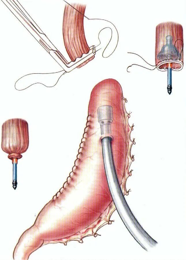 Антиперистальтический анастомоз. Пищеводно желудочный анастомоз. Тонкотолстокишечный анастомоз. Эзофагеальный анастомоз. Анастомоз пищевода