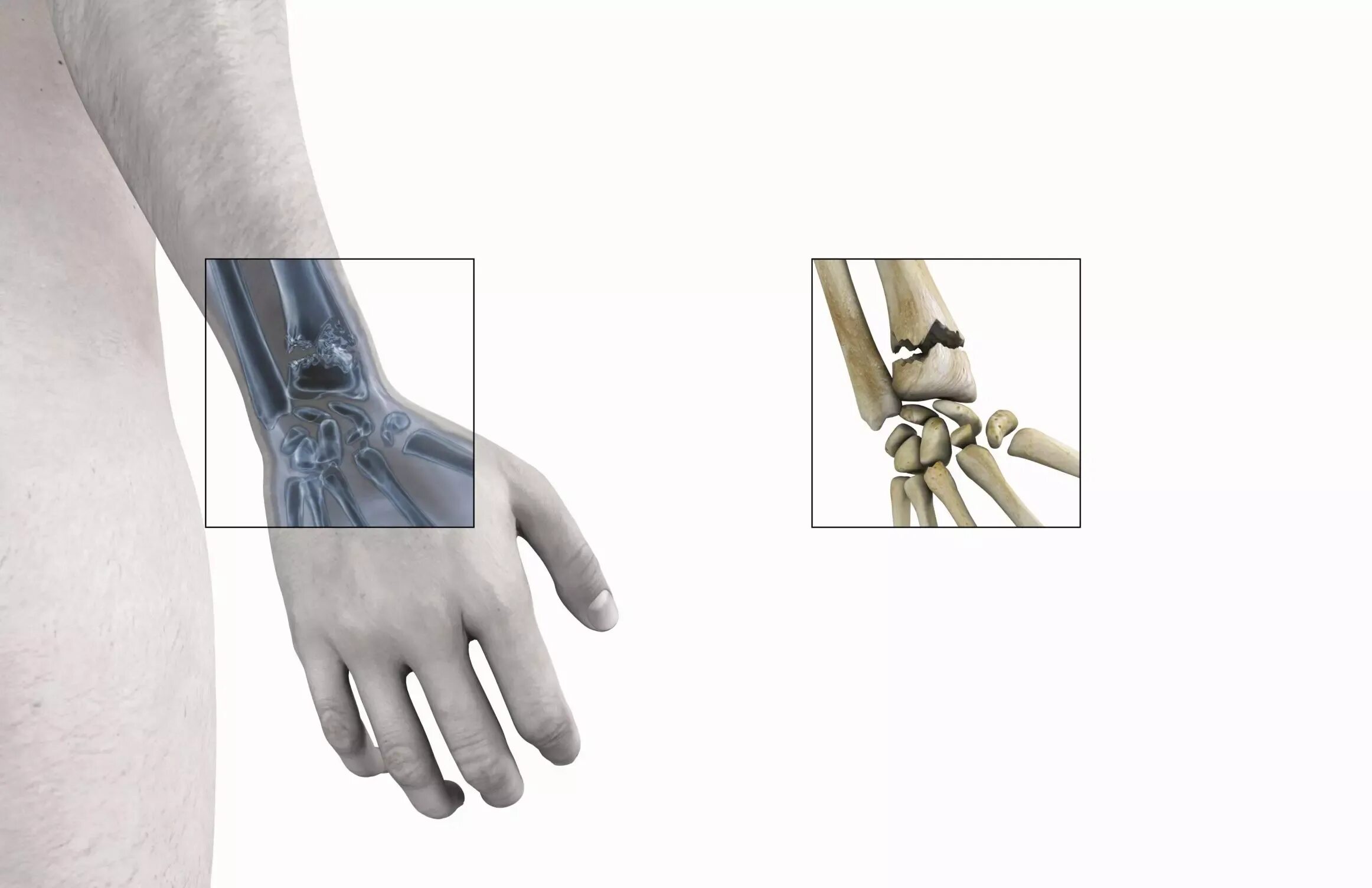 Перелом лучевой кости кисти. Перелом лучевой запястной кости. Перелом лучезапястного сустава рентген. Перелом ладьевидной кости кисти руки.