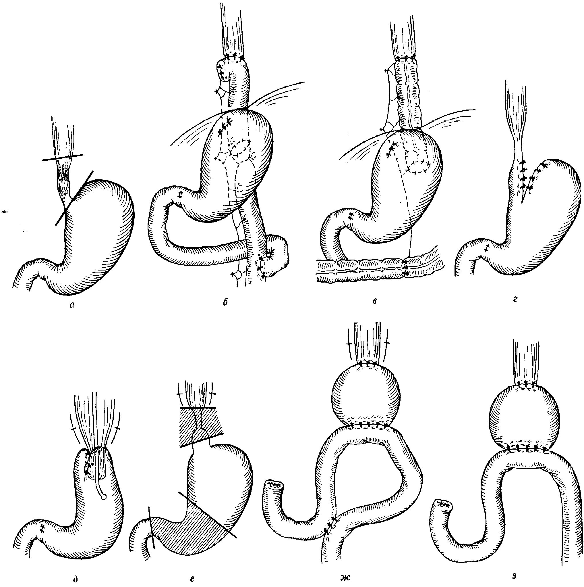  Операция Льюиса -экстирпация пищевода. Операция Льюиса пищевод. Пилоросохраняющая резекция желудка. Трансгиатальная экстирпация пищевода. Операция желудка кишечника