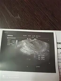 Узи на раннем сроке отзывы