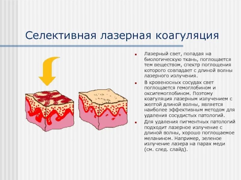 Лазерная селективная коагуляция. Коагуляция мягких тканей. Селективной лазеркоагуляция.