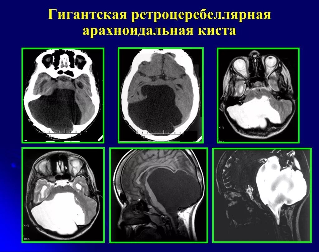 Чем опасна киста в мозгу. Ретроцеребеллярная киста мрт. Киста задней черепной ямки кт. Арахноидальная киста задней черепной ямки кт. Ретроцеребральная киста мрт.