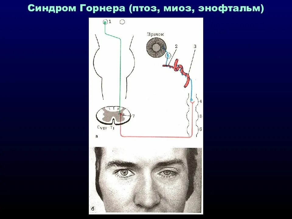 Триада горнера при раке. Симптом бернара горнера. синдром клода бернара горнера. симптомокомплекс клода-бернара-горнера. триада бернара горнера.
