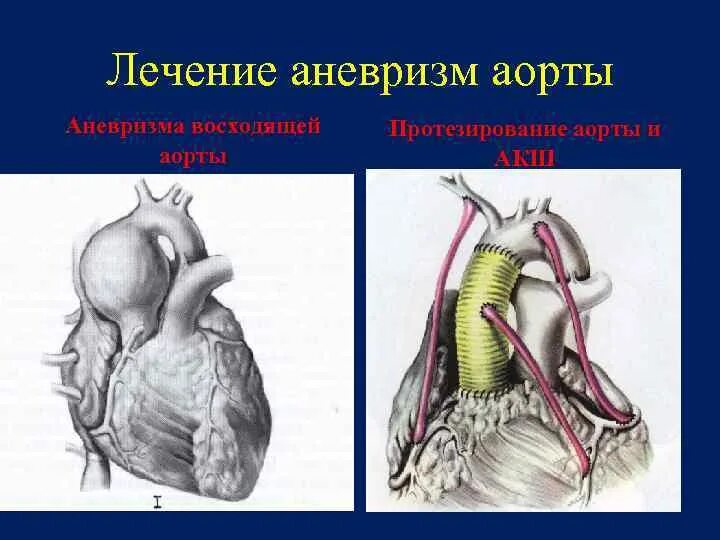 Аневризма восходящей аорты операция. Аневризма восходящей аорты. Протезирование восходящего отдела аорты. Протезирование аорты брюшной полости.