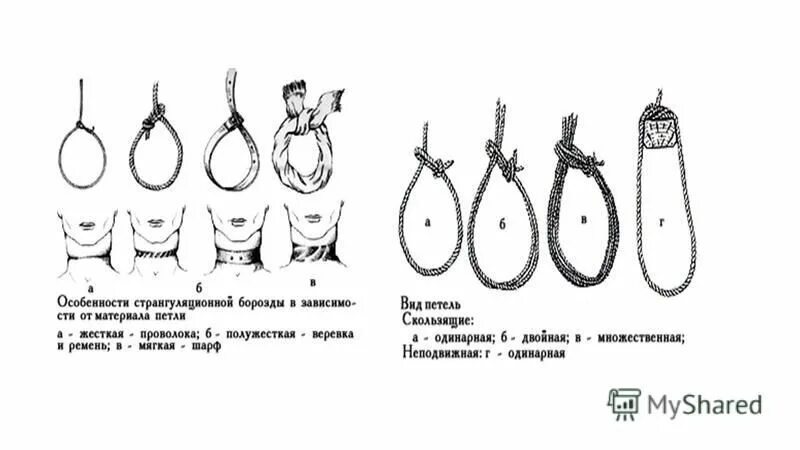 Повешение борозда. Странгуляционная борозда судебная медицина. классификация петель при повешении. особенности странгуляционной борозды. судебно медицинская характеристика странгуляционной борозды.