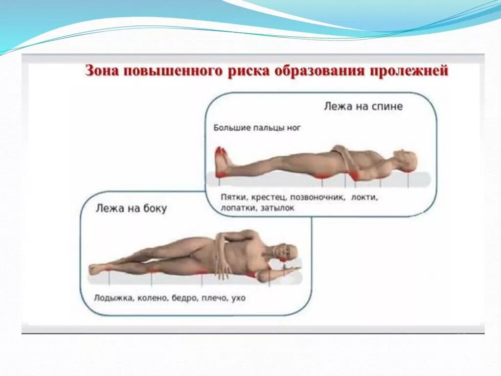 Места пролежней у лежачих больных. Профилактика пролежней после операции. Зоны риска образования пролежней. Можно ли пить лежа