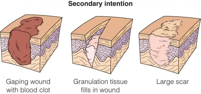 What is a wound. What is a wound