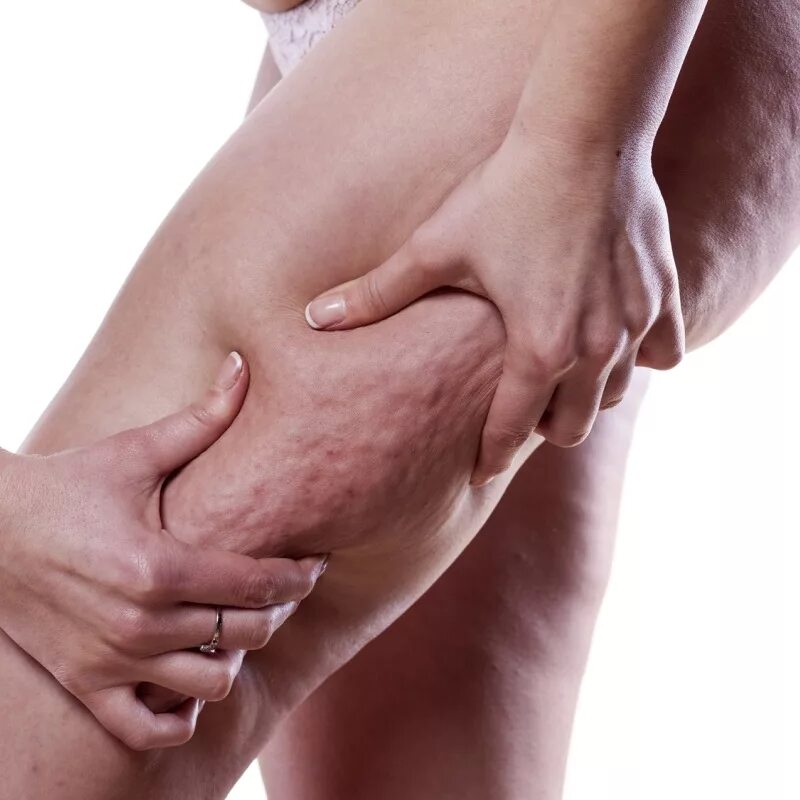 целлюлит у мужчин