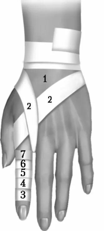 как зафиксировать указательный палец. ортез шина фиксатор на палец руки фирма экотен fc-002b. разрыв сухожилия разгибателя пальца шина. схема тейпирования кистевого сустава среднего пальца. как зафиксировать указательный палец.