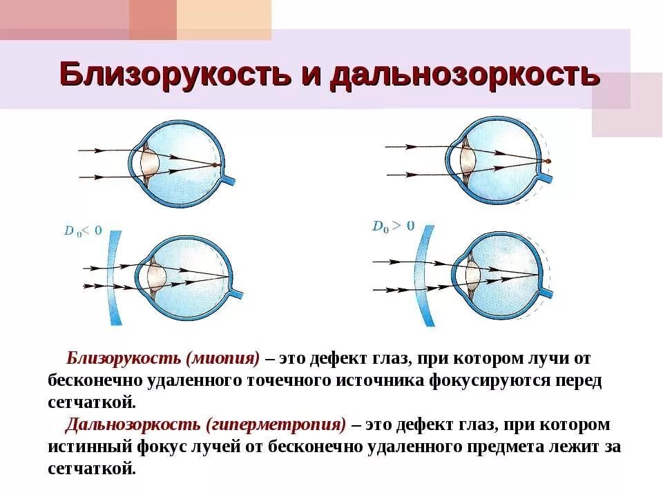 Операция при дальнозоркости. Зрение близорукость и дальнозоркость. Линзы для близорукости и дальнозоркости физика. Изменения в глазу при дальнозоркости и близорукости. Близорукость и дальнозоркость схема физика.