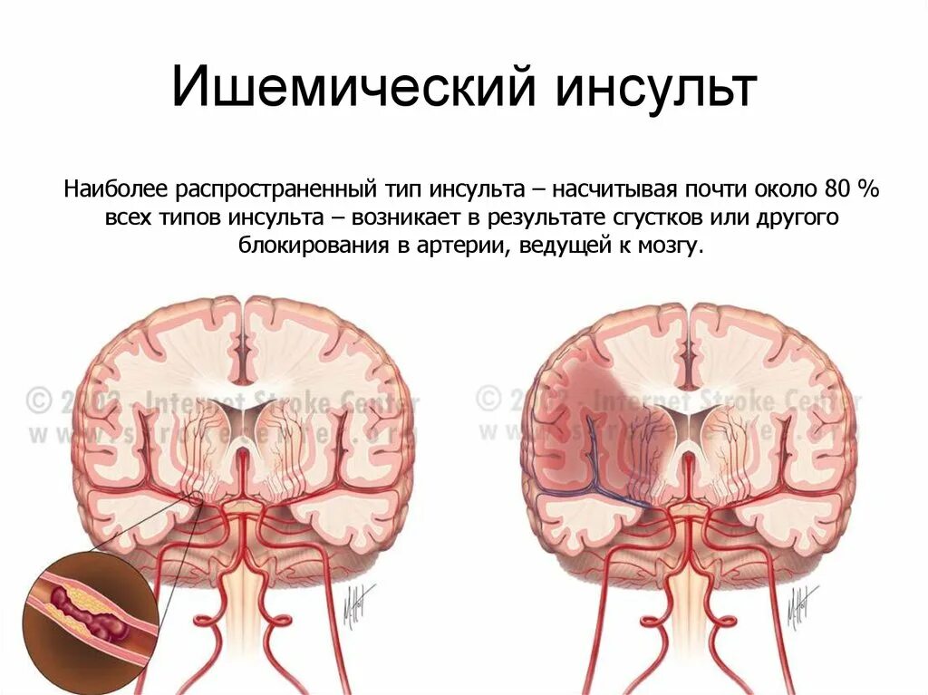 Ишемический инсульт 2023. Типы ишемического инсульта. Инсульт виды самый распространенный. Кт головного мозга при ишемическом инсульте.