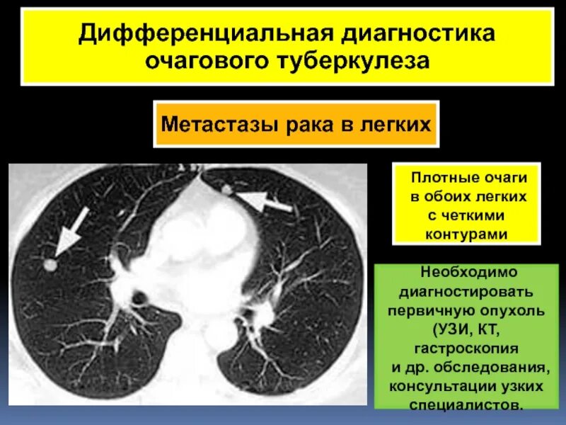 Диагноз метастазы. Диф диагноз очагового туберкулеза легких. диф диагностика очагового туберкулеза легких. дифференциальный диагноз очагового туберкулеза. очаговый туберкулез дифференциальная диагностика.