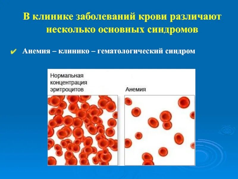 Аллергическая анемия. Анемия при остром лейкозе обусловлена. Болезни системы крови анемия, лейкоз у детей. Причины анемии при лейкозах. Заболевания связанные с эритроцитами.