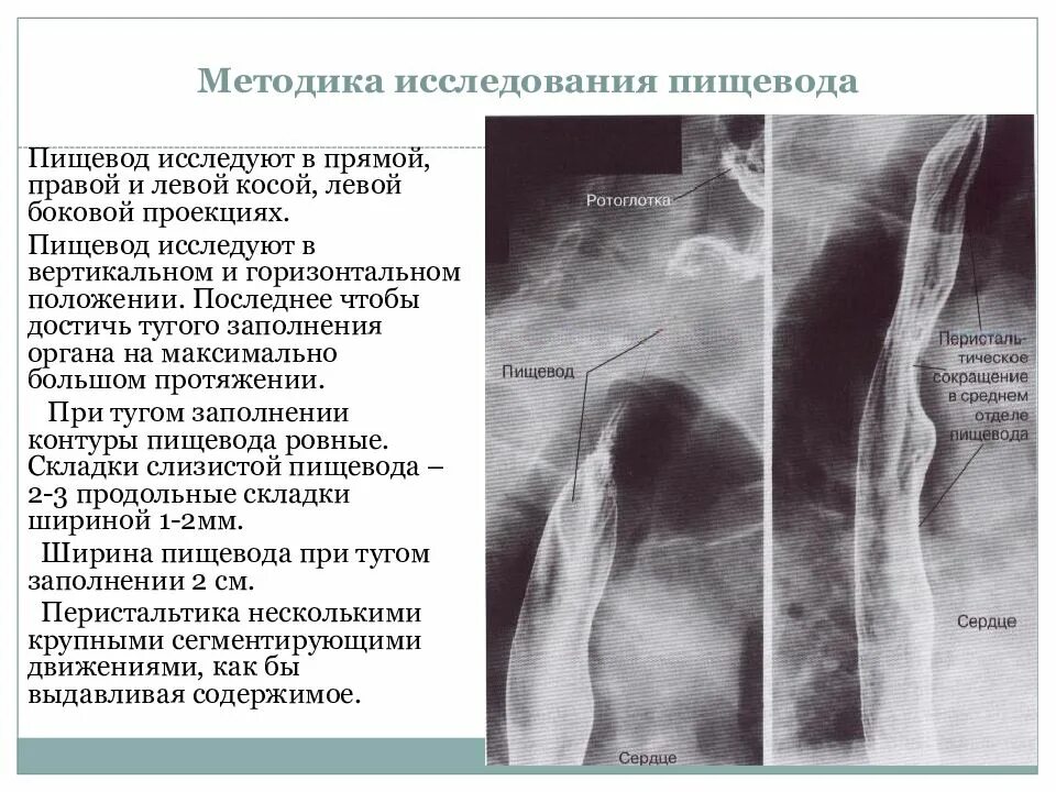 Методы обследования пищевода. Рентгенодиагностика заболеваний пищевода. Правая косая проекция пищевода. Пищевода в боковой проекции. Нижнее расширение пищевода