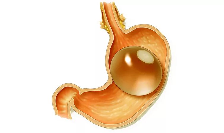 внутрижелудочный баллон производители. внутрижелудочный баллон nbp. внутрижелудочный баллон. внутрижелудочный баллон. внутрижелудочный баллон.