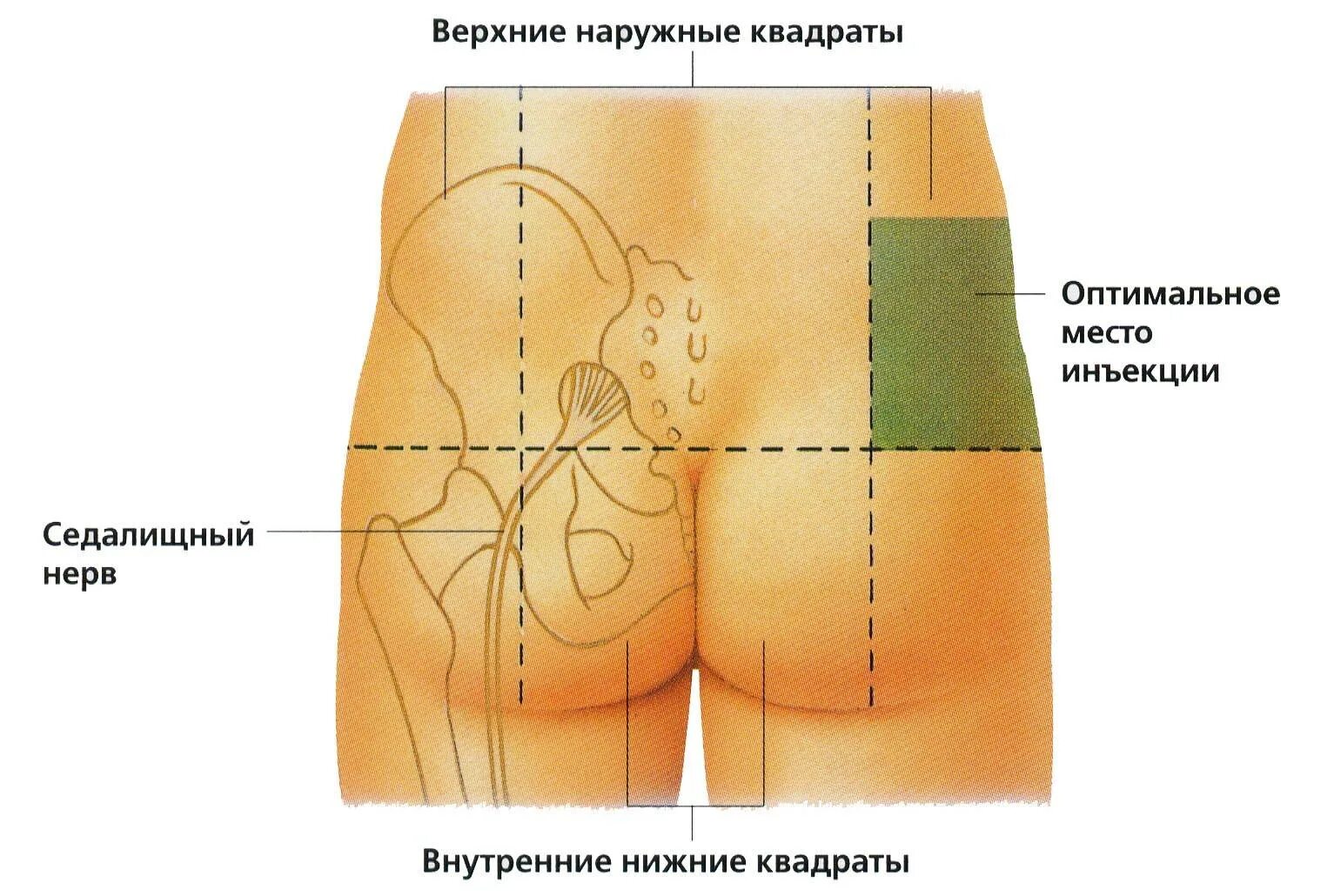Правильно сделать внутримышечный. Укол в верхний наружный квадрант ягодицы. как правильно сделать внутримышечный укол в ягодицу. схема внутримышечной инъекции в ягодицу. куда ставить укол в ягодицу внутримышечно правильно.