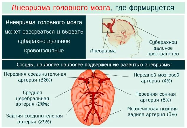 Аневризма головного мозга симптомы последствия лечение. Аневризм сосудов головного мозга. микроаневризма сосудов головного мозга симптомы. аневризм головного мозга что это такое симптомы. аневризма мозговой артерии симптомы.