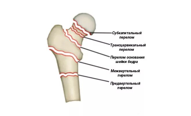 Перелом проксимального отдела бедренной кости. Классификация переломов шейки бедренной кости. Субкапитальный перелом шейки бедра. Субкапитальный перелом шейки бедренной кости со смещением. Шейка бедра заживает