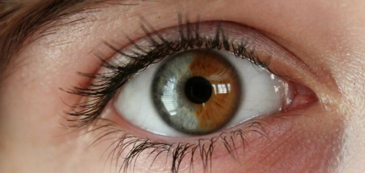 Один глаз серый другой. Центральная гетерохромия радужной оболочки. Секторная гетерохромия глаза у человека. Центральная гетерохромия хамелеон. Гетерохромия карих глаз.