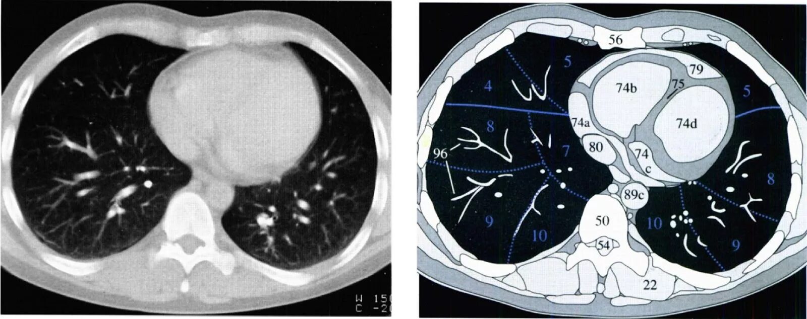 Фронтальный срез кт. Срезы кт. Срезы при кт. Компьютерная томография легких. Срезы кт.