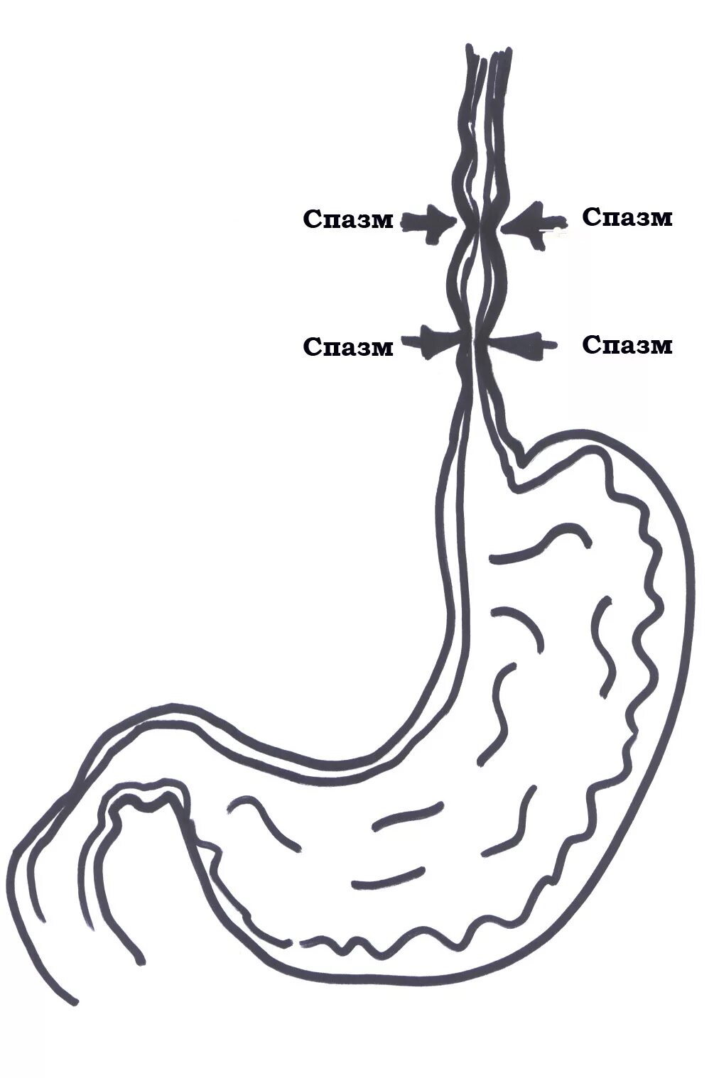 Как снять спазм желудка. Диффузионный спащм пищевода. Спастические сокращения пищевода.
