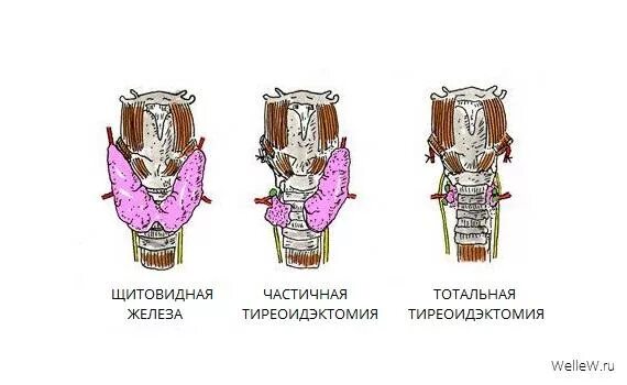 Сколько длится операция щитовидной. Тотальная тиреоидэктомия щитовидной железы. Операция щитовидной железы шов. Резекция доли щитовидной железы.