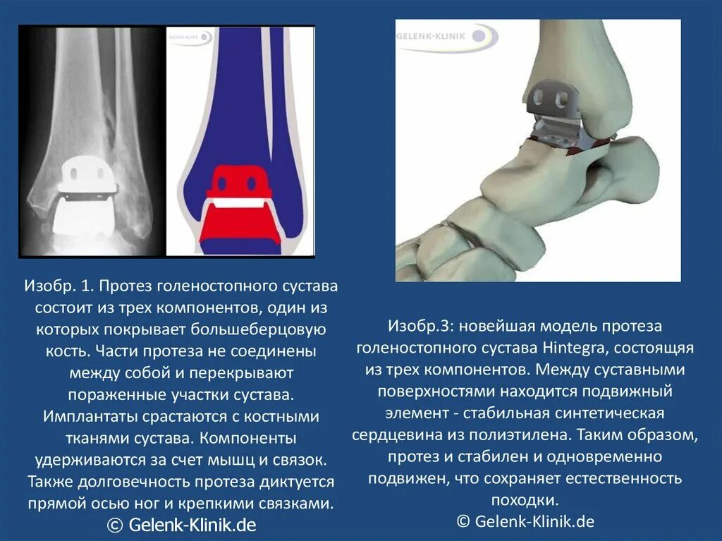 Голеностопный сустав клиника. Эндопротезирование таранной кости. Эндопротезирование голеностопа. Имплант голеностопного сустава. Протезирование голеностопного сустава.