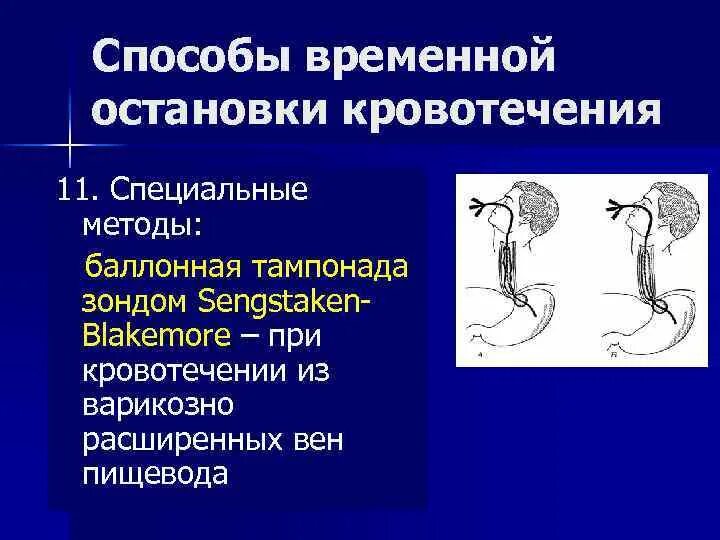 Кровотечения пищевода печени. Методы остановки кровотечения из варикозно расширенных вен пищевода. Кровотечение из варикозно расширенных вен пищевода. Классификация варикозно расширенных вен пищевода эндоскопическая. Варикозно расширенные вены пищевода.