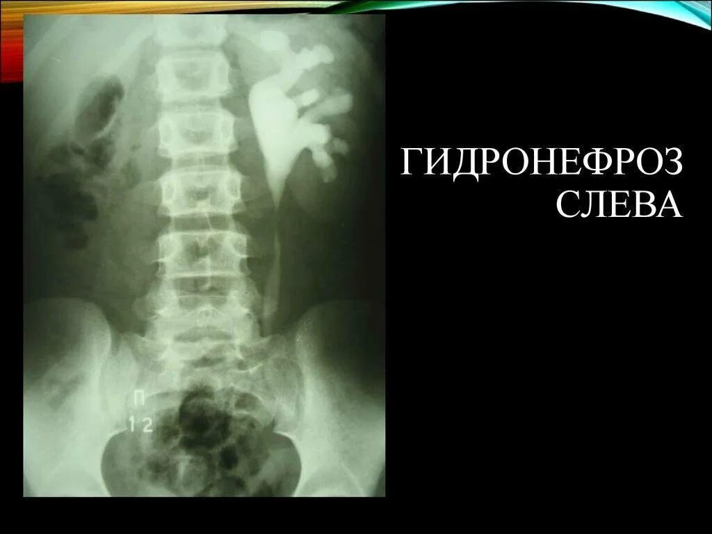 Гидронефроз что это и как лечить. Экскреторная урография гидронефроз. гидронефроз степени рентген. врожденный гидронефроз рентген.