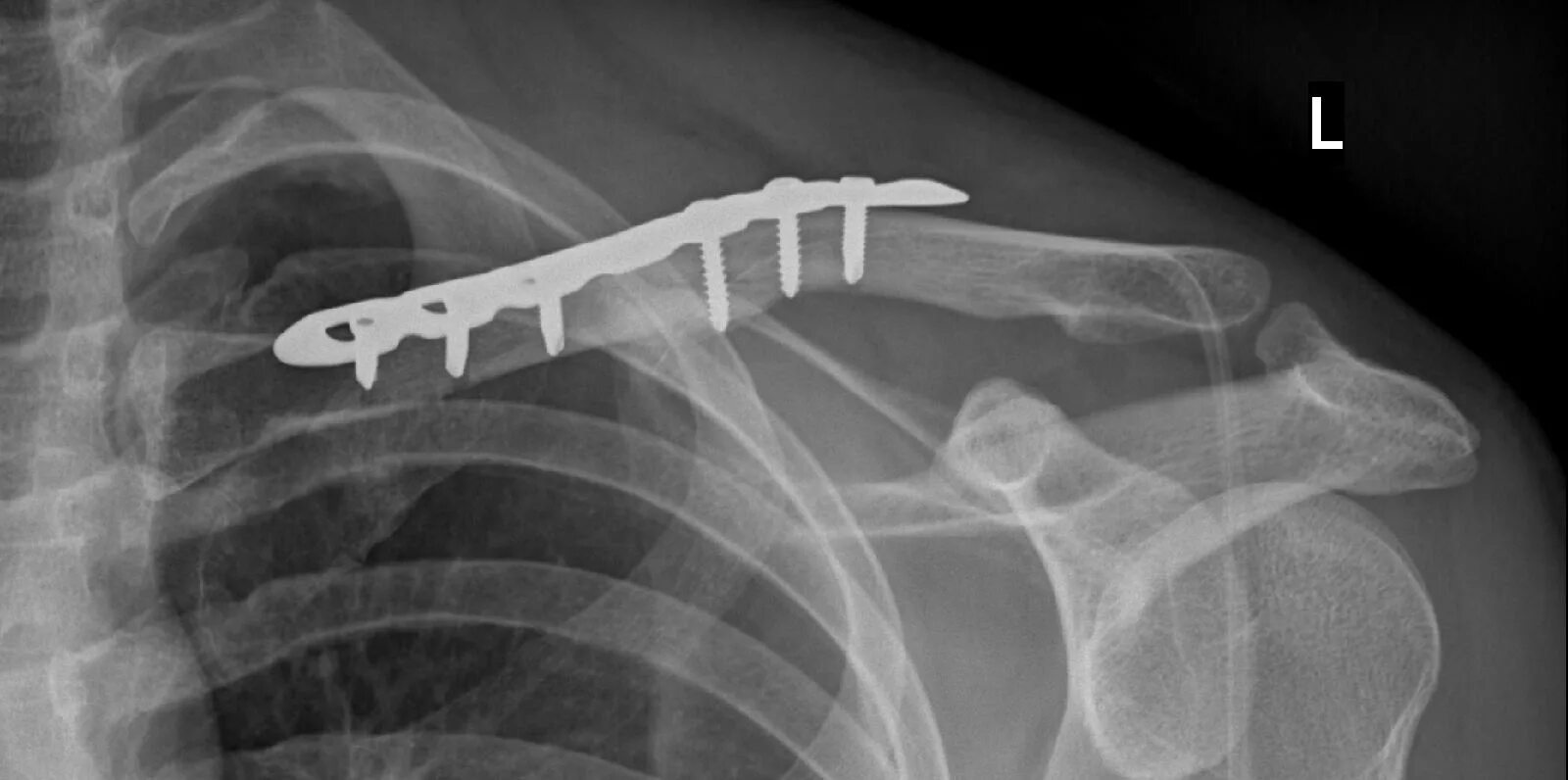 операция удаление ключицы. экстрамедуллярный остеосинтез ключицы. операция удаление ключицы. перелом ключицы операция. остеосинтез ключицы пластиной.