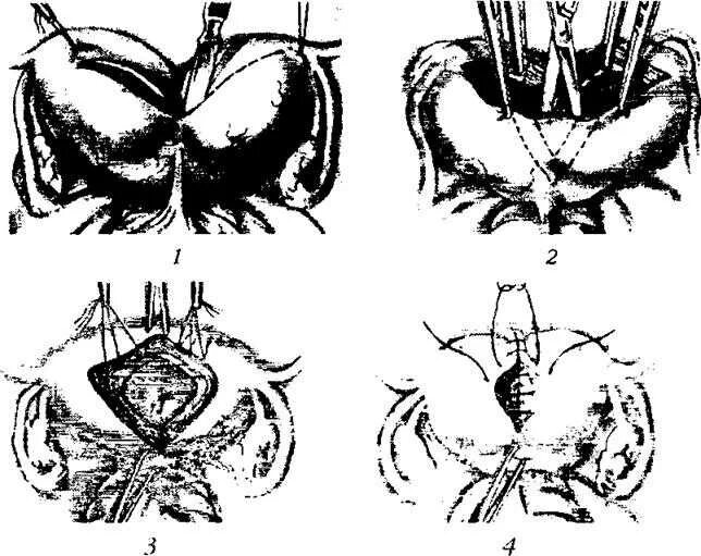 Манчестерская операция в гинекологии. Манчестерская операция. Операция пластика влагалища Манчестерская. Манчестерская операция ход операции.