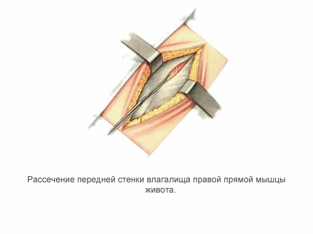 Рассечение термин. Швы на рассеченные мышцы. рассечение кольцевидной связки.