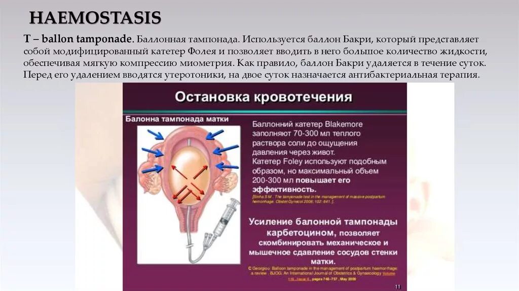 Кровотечение при раке матки. Баллонная тампонада- катетер Бакри. Баллонная тампонада при кровотечении. Баллонная тампонада матки алгоритм. Баллон для тампонады матки.