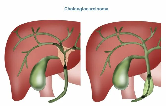 Злокачественную опухоль желчного. Опухоль печени клацкина. Холангиокарцинома желчных протоков. Холангиокарцинома внутрипеченочных желчных протоков. Воротная холангиокарцинома.